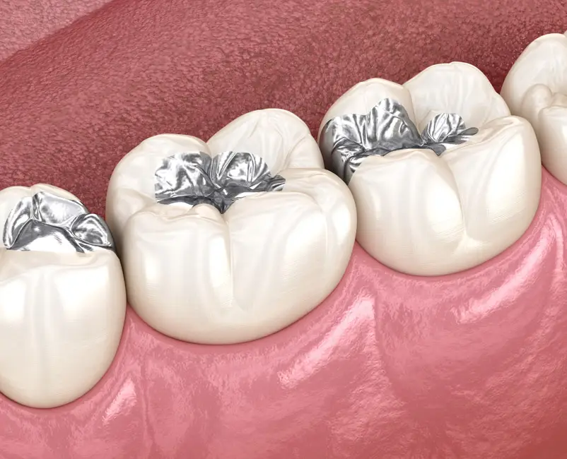 Cedar Smiles Cosmetic & Family Dentistry Amalgam Fillings
