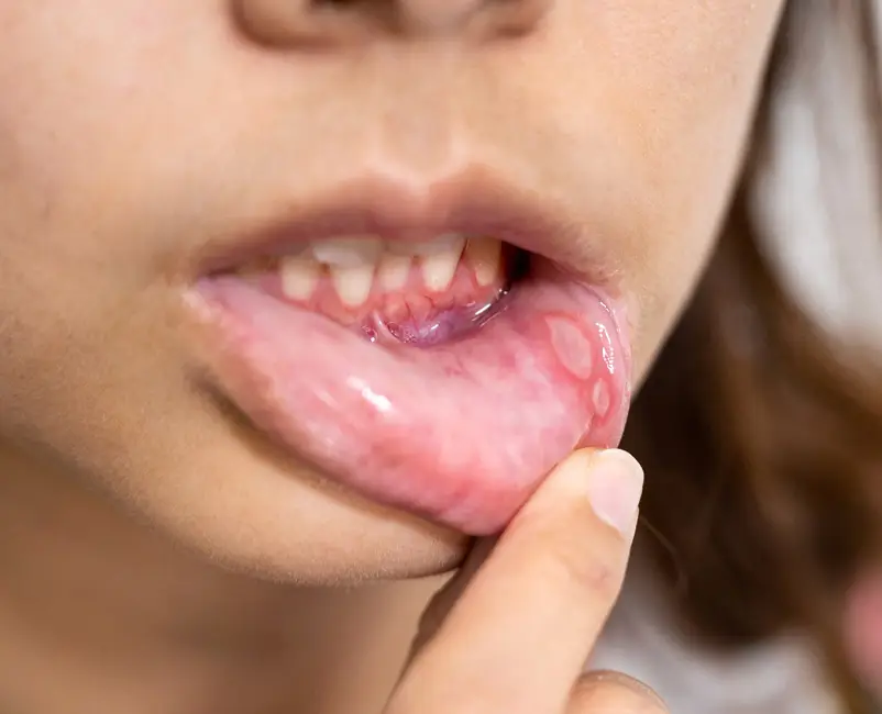 Mouth Ulcers